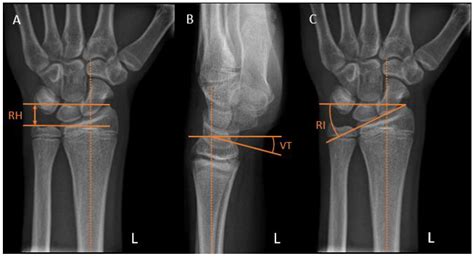 Indications and Timing of Guided Growth Techniques for Pediatric Upper ...
