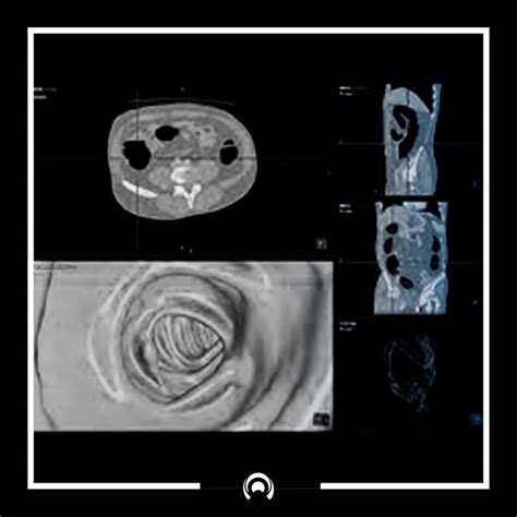 Image result for Endoscopia Virtual Colon