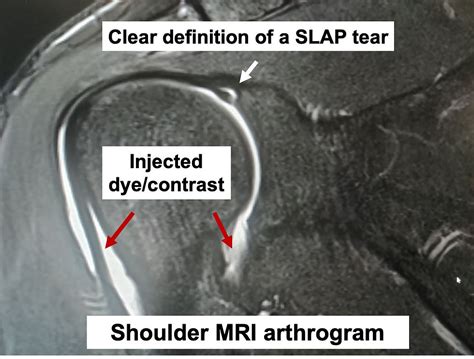 Mr Arthrogram Shoulder 的图像结果