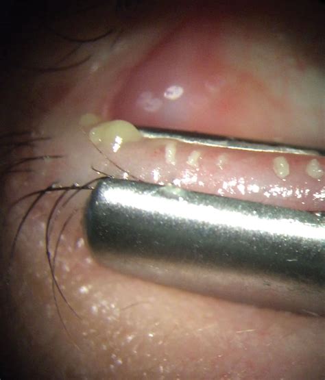 Normal Meibomian Gland