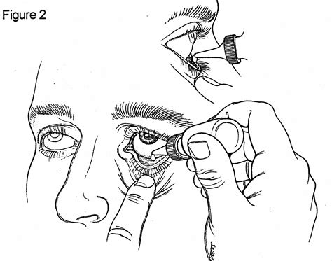 Help with Applying Eye Drops and Ointments - Eye Physicians & Surgeons