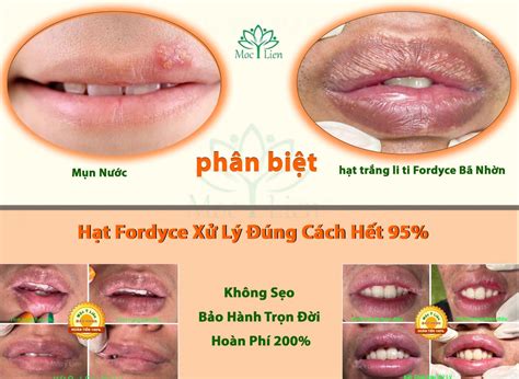 Phun Môi về bị nổi mụt nước Herpes và Cách Phân Biệt Mụn Nước Herpes và Hạt Fordyce Bã Nhờn