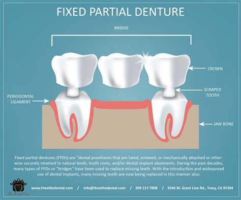 Fixed Partial Dentures