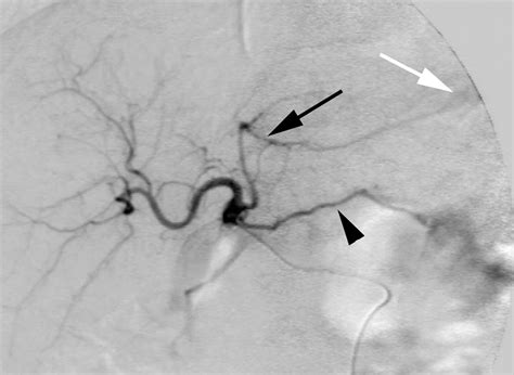 Left Gastric Artery Angiogram Xmlinkhub