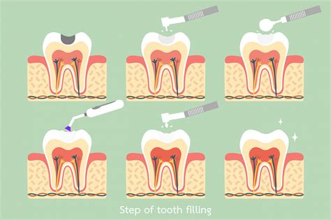 How Painful Is Teeth Filling at Joseph Shupe blog