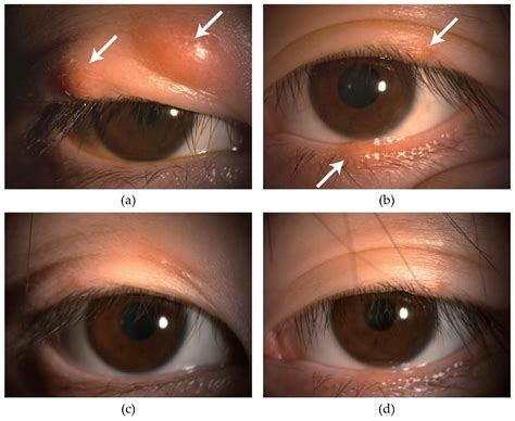Therapeutic Efficacy and Safety of Intense Pulsed Light for Refractive ...