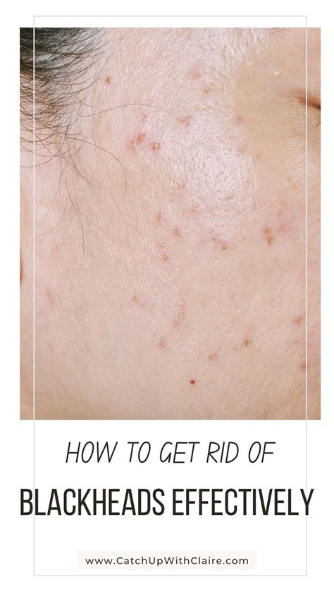 How to prevent blackheads – Artofit - how to prevent blackheads