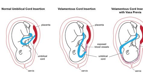 Placenta Umbilical Cord Stage at Yi Voss blog