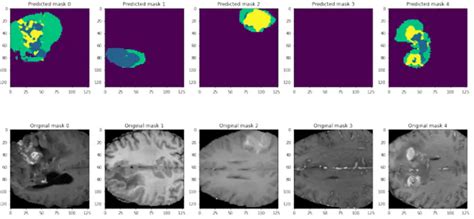Image result for Brain Tumor Segmentation with Python Code