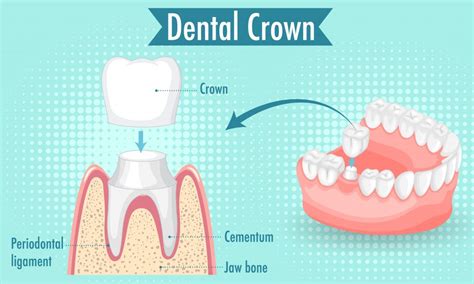 Dental Crown: Types, Procedure, And Cost.
