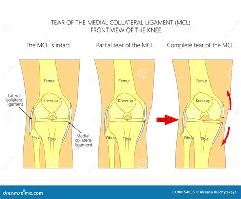 Ligaments Du Knee_Tear Du Ligament Collatéral Médial Illustration de Vecteur - Illustration du ...