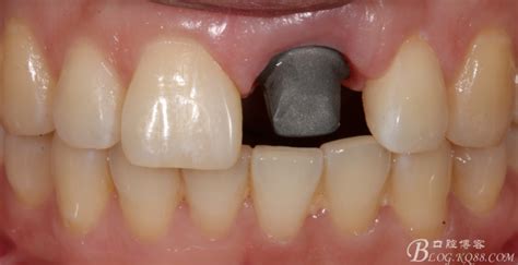 即刻种植牙案例分享-武汉牙医嵇强的博客-KQ88口腔博客