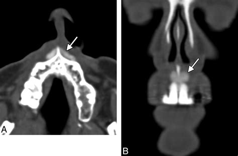 Anterior Nasal Spine Fracture