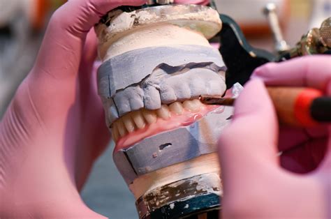 Image result for Immediate Denture Process