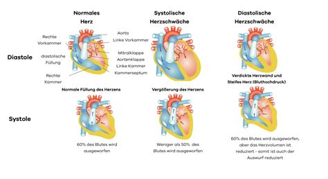 Atemnot und hoher Blutdruck - Warum Sie keine Luft kriegen