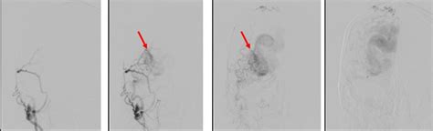 Image result for AVM Brain