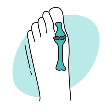 Foot Bursitis | Intermetatarsal Bursitis | Retrocalcaneal bursitis