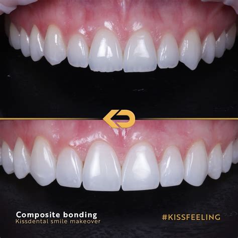 Composite Bonding - Kissdental | Composite bonding, Dental composite ...