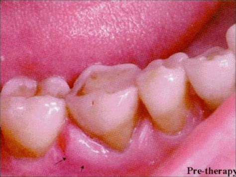 牙周脓肿反复发作的治疗经历-别有病 Byb.cn-纯自然疗法 攻克亚健康