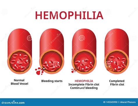 Hemophilia. Damaged Blood Vessel, Haemophilia Coagulation Disorder - Vector Stock Illustration ...