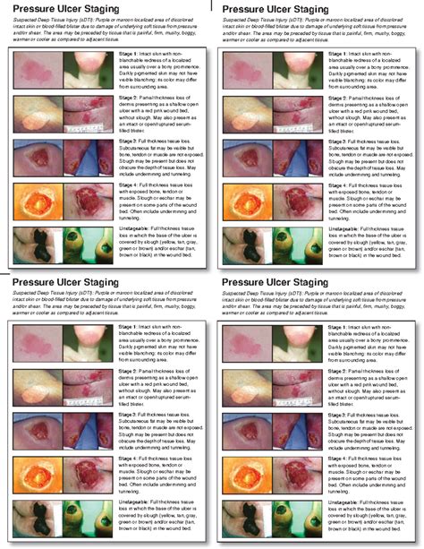 Pressure ulcer staging card - NUR 242 - Studocu