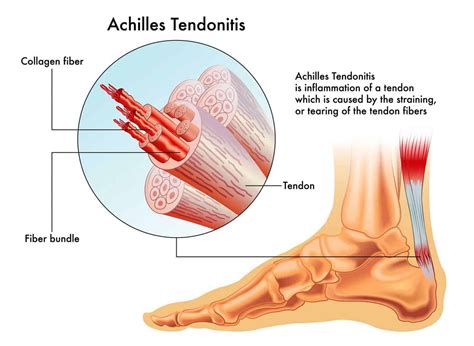 Achilles Tendon (Human Anatomy): Function, Location, and Injuries – Injury Health Blog
