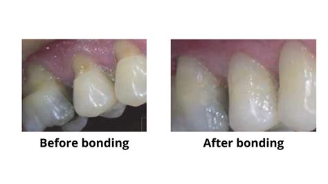 Composite bonding vs. porcelain veneers: Which one meets your needs?