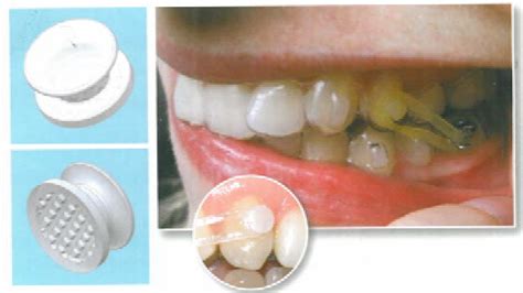 Invisalign Buttons 的图像结果