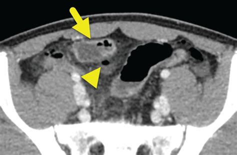 Meckel Diverticulum Scan