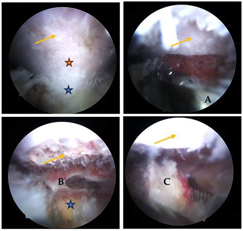 Arthroscopic Excision of Scapular Exostoses: A Technical Note