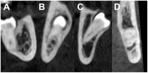 Neurosensory Deficits of the Mandibular Nerve Following Extraction of ...