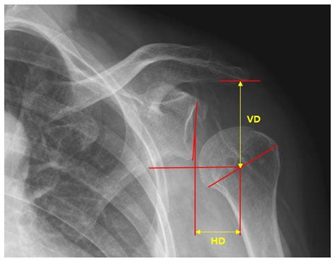 Elastic Dynamic Sling on Subluxation of Hemiplegic Shoulder in Patients ...