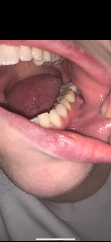 Painless bumps on gums. What are they? My dentist apt isn’t till 3/30 ...