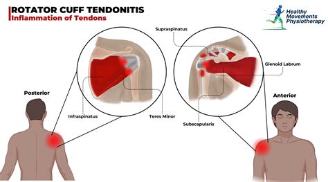 Shoulder Physio & Injury Treatment | Healthy Movements Physio