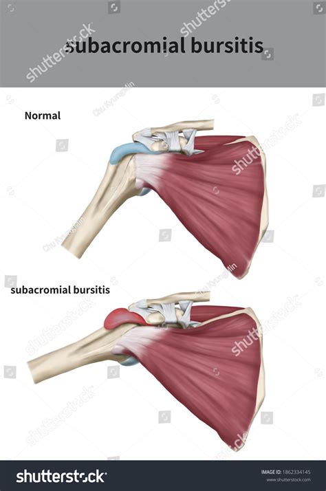 Subacromial Subdeltoid Bursitis