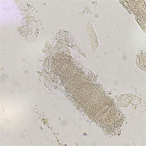 Granular Cast In Urine