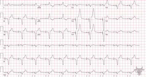Paced Rhythms | ECG Stampede