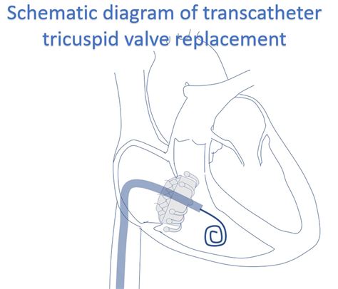 Tricuspid Valve Replacement