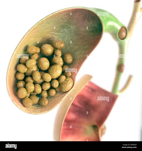 Gallstones in gallbladder and bile duct - high details - 3D rendering Stock Photo - Alamy