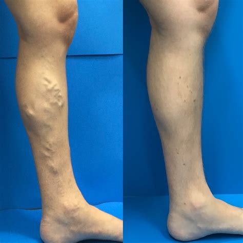 Varicose Veins In Legs 5 Hidden Dangers Of Varicose Veins Elite Vein