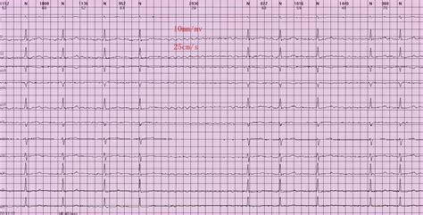心电图图例分析：心房颤动、三度房室传导阻滞、交界性逸搏心律 - 爱爱医医学网