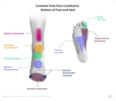 Common Foot Pain Conditions [2023] | Foot pain, Feet care, Writing therapy