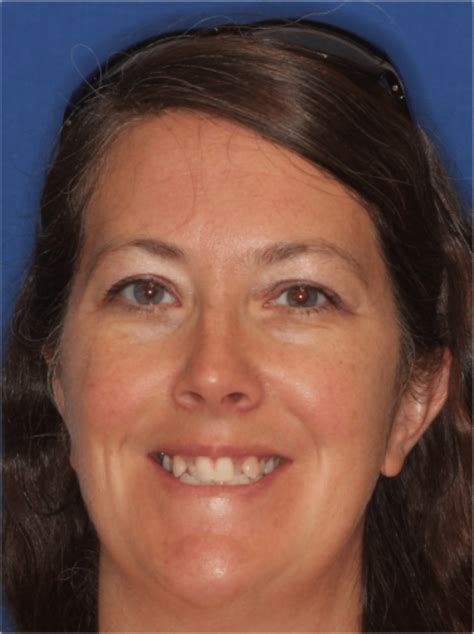 Orthodontics | Grove Dental Associates