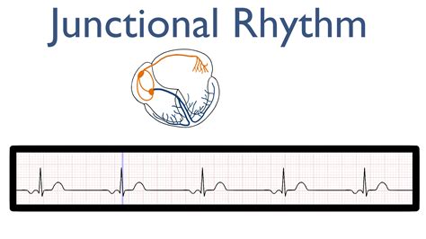 Junctional Rhythm – Nursing Unraveled