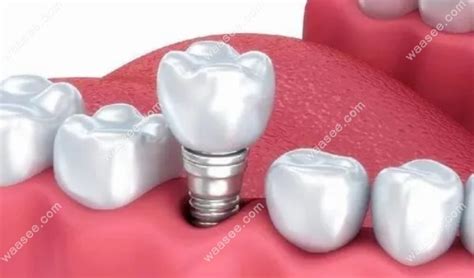 瑞士SIC种植体和ITI种植牙哪个好?细说二者的区别和价格 - 口腔资讯 - 牙齿矫正网