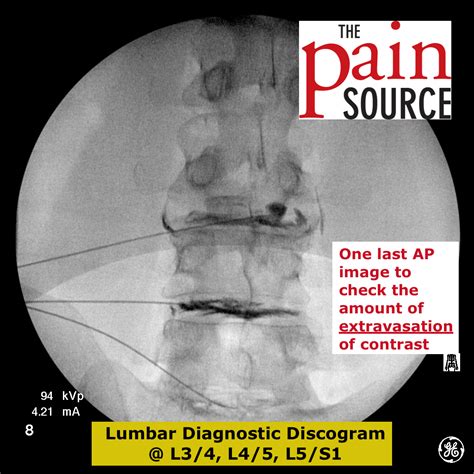 Image result for Lumbar Discogram