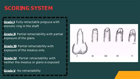 PHIMOSIS PARAPHIMOSIS | PPTX