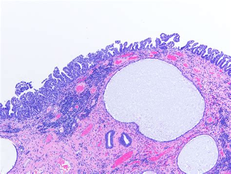 Pathology Outlines - Serous carcinoma
