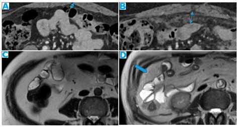 Unravelling Peritoneal Carcinomatosis Using Cross-Sectional Imaging ...