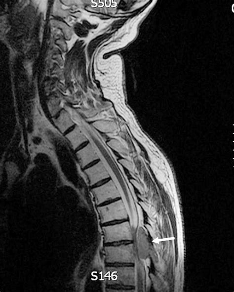 Spinal Cord Compression 的图像结果